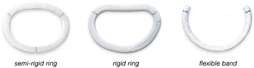 Semi-rigid ring, rigid ring, flexible band